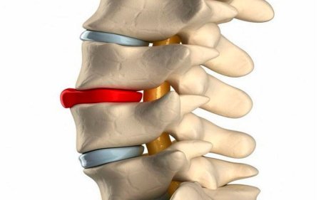 Протрузия межпозвоночного диска